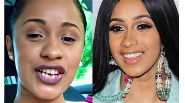 cardi b teeth before after
