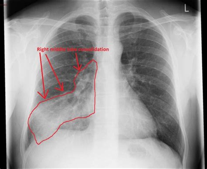 Pneumonia