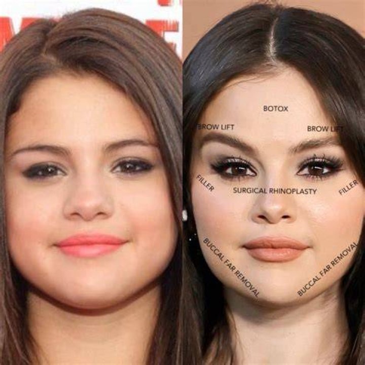 Selena Gomez Plastic Surgery