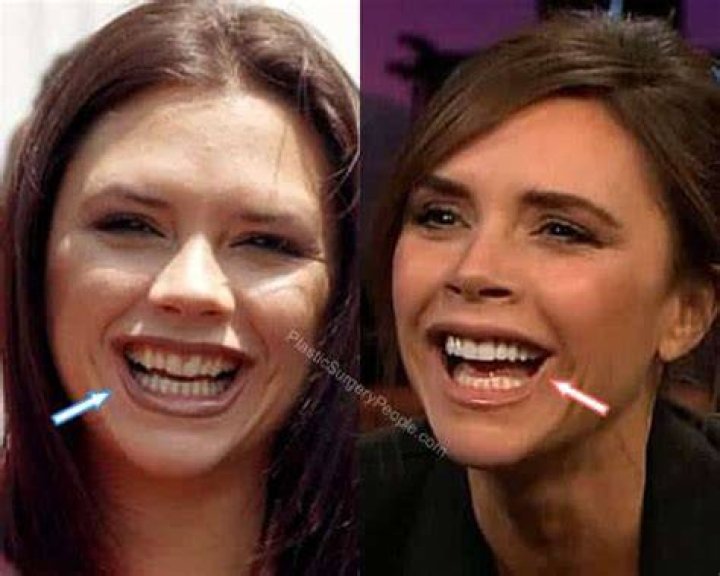 victoria beckham teeth